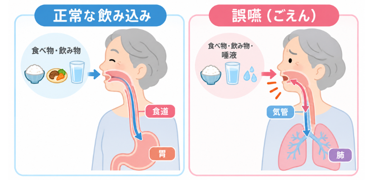 正常な飲み込みと誤嚥の違いが分かる図解